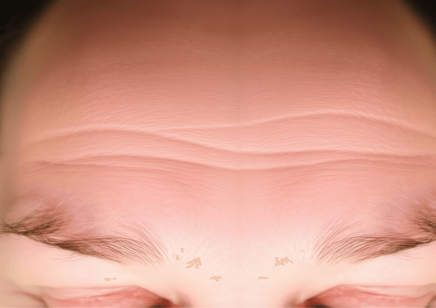 How to Reduce Fine Lines on Forehead​