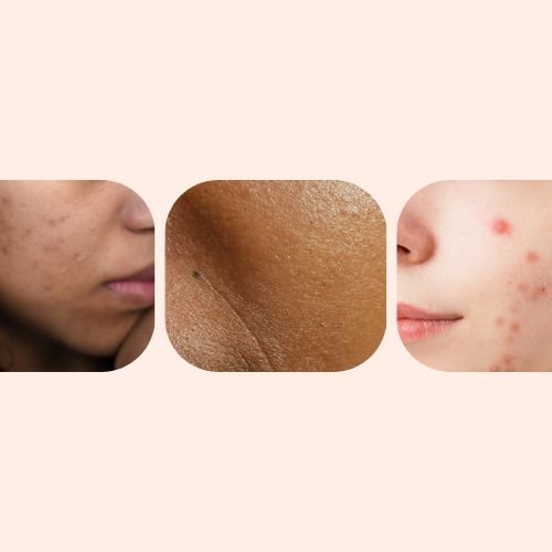 Clogged Pores vs Closed Comedones vs Acne: The Differences